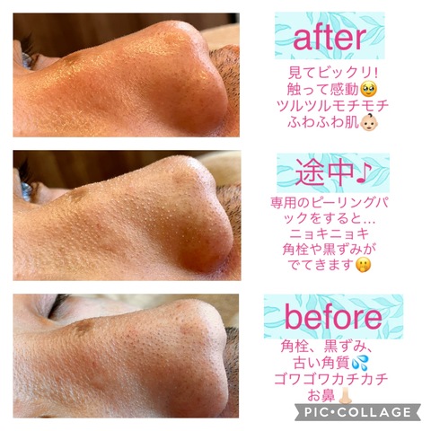 ピーリング&毛穴洗浄でスッキリ